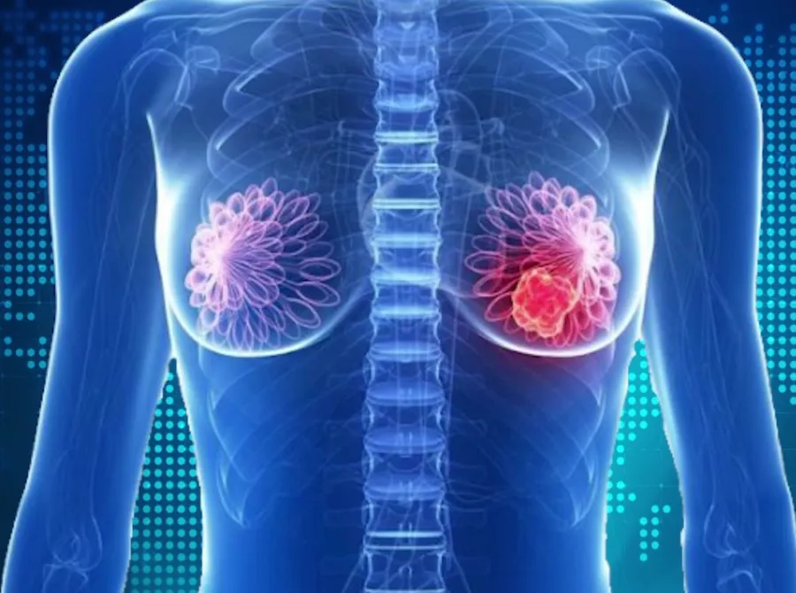 Brasil amplia diagnóstico precoce de câncer de mama e colo do útero