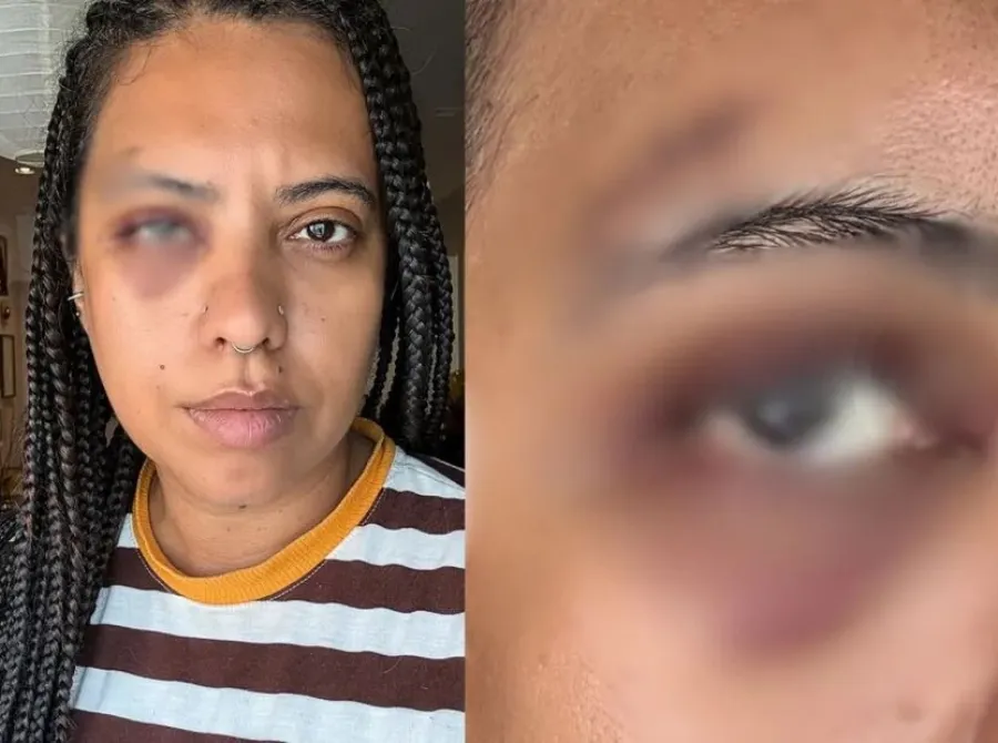 Influenciadora leva seis pontos após agressão em roda de samba no Rio